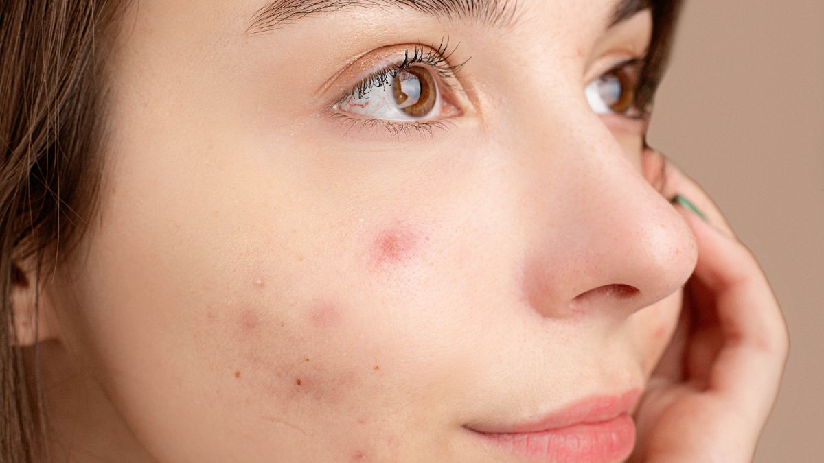 Acne: Causes, prevention, and treatment of acne, including natural remedies and over-the-counter products.