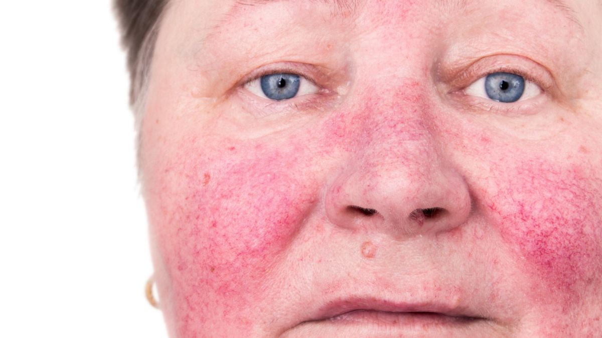 Rosacea: Causes, prevention, and treatment of rosacea, including lifestyle changes and prescription medications