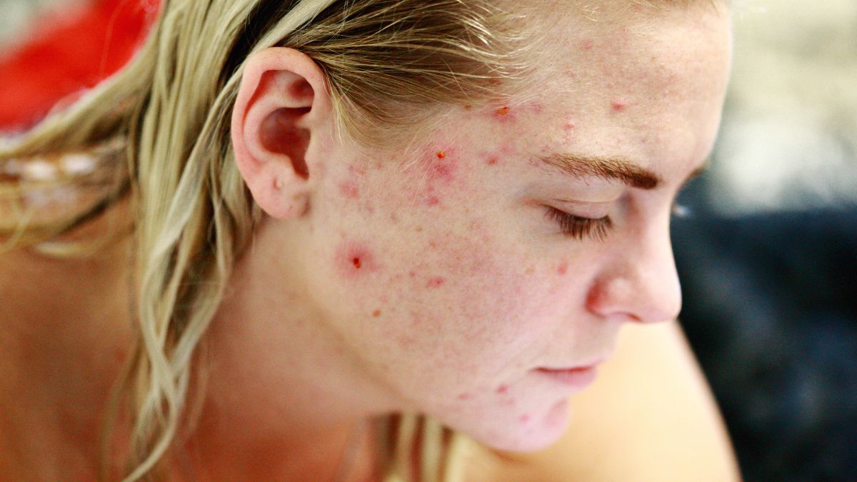 What are the different types of Acne?