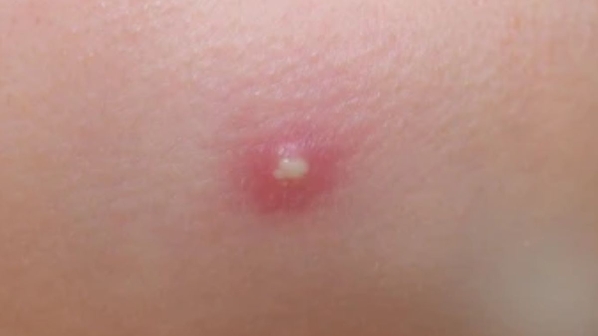 Pustules: Causes, Treatment, and Prevention of this Type of Acne